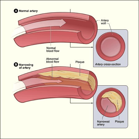 a closer look at the inner part of the coronary artery