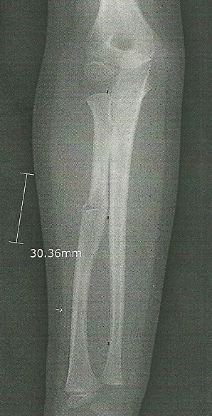 Her X-Ray Showing the Break and Lesion Size