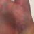 Bruising after the fall Bruising after the fall