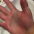 Bruised hand Bruised hand