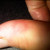A VERY sore spot developed after I slept in my hard cast! A VERY sore spot developed after I slept in my hard cast!