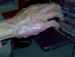 Severe burns often causes death or handicap for whole life