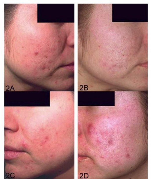 Acne Examples 