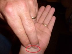 carpal tunnel home diagnosis test