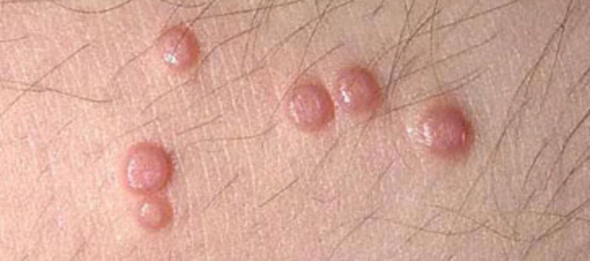 Bumps Under Skin On Vagina 70