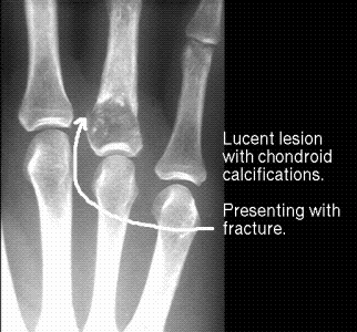 LYTIC BONE LESION | HubPages