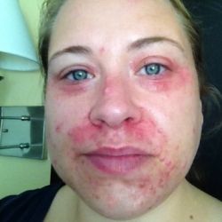 Peri oral dermatitis, chinese naked woman