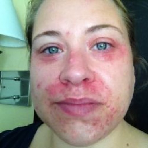 Pictures of perioral dermatitis