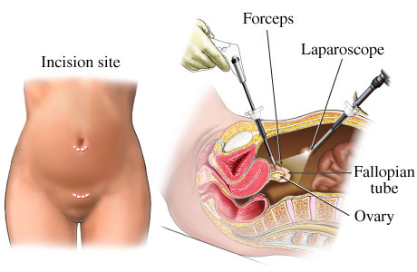 Laparoscopic tubaligation