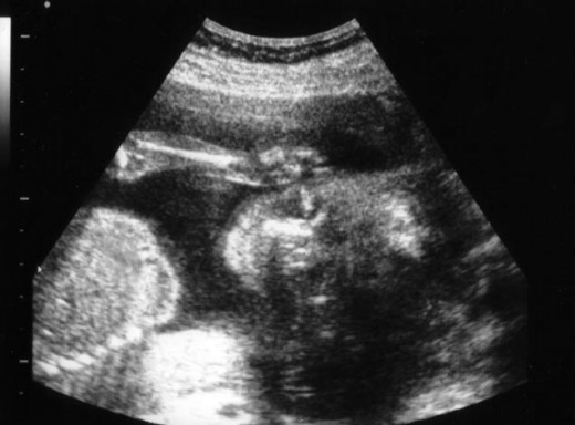 My son at 21 weeks