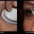 Sun spot removal before and about 1 month after 1 treatment. Sun spots respond very well to laser treatment. Sun spot removal before and about 1 month after 1 treatment. Sun spots respond very well to laser treatment.