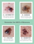 Malignant Cancerous Moles, What are the Signs, Detection, Symptoms and ...