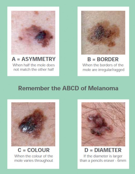 How to detect a skin cancer (Part - I) ? | hubpages