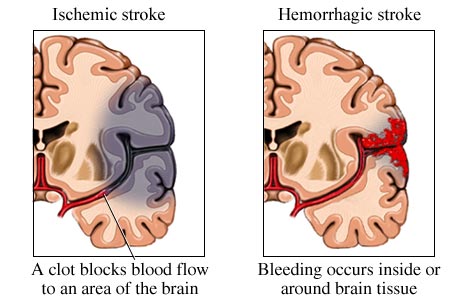 Brain ischemia versus brain hemorrhage 