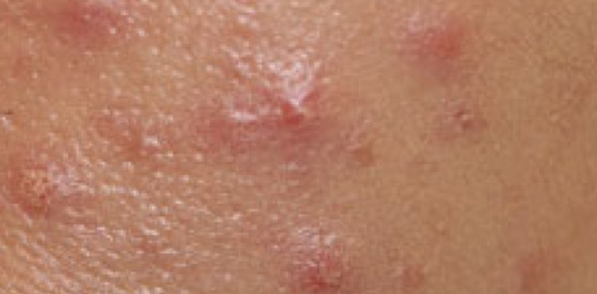 Rash in vaginal area - Dermatology - MedHelp