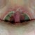 Two days after a tonsillectomy. Notice the scabs are already beginning to form. Two days after a tonsillectomy. Notice the scabs are already beginning to form.