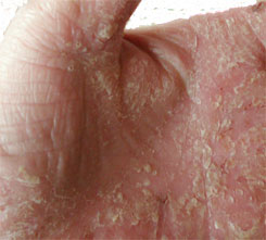 The hand of a man suffering from Psoriasis
