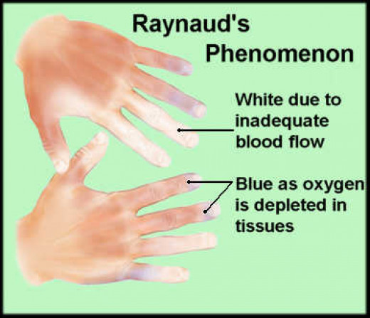 Raynaud's Syndrome | hubpages