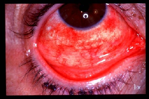Bad pink eye infection