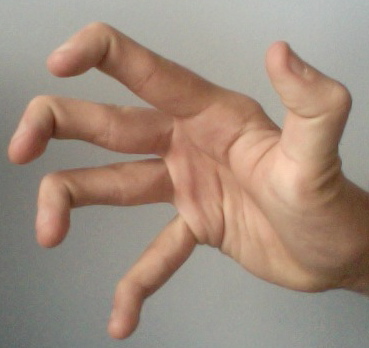Rheumatoid Arthritis