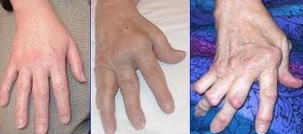 Deformed Hands Due to RA