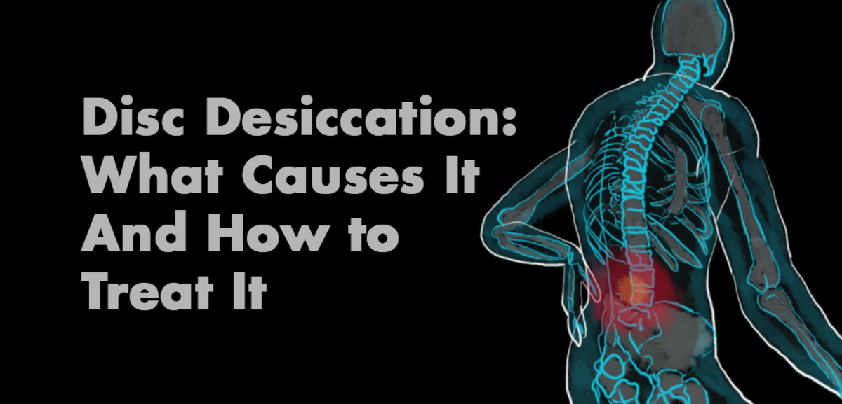 Disc Desiccation: Cause & Treatment of Desiccated Discs
