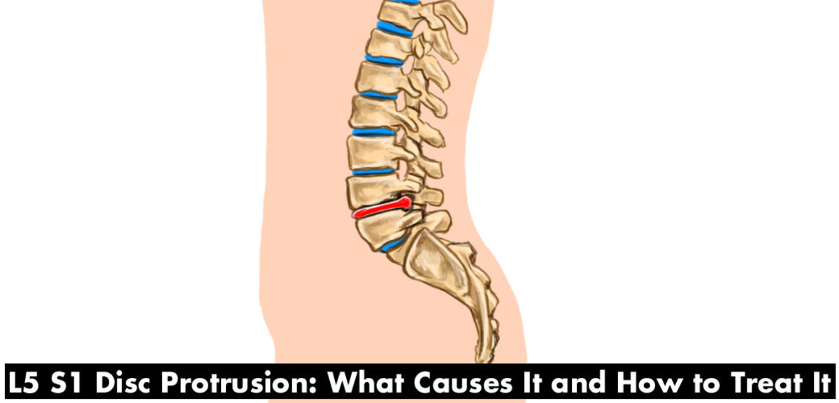 L5 S1 Disc Protrusion—Causes and Treatment of Back Pain
