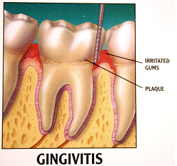 what does gingivitis look like?