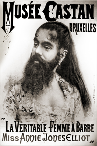 "Annie Jones" by Unknown - Poster. Licensed under Public domain via Wikimedia Commons  Annie Jones suffered from the genetic condition hypertrichosis, as did other circus Bearded Ladies. This did not stop them marrying and leading normal lives.