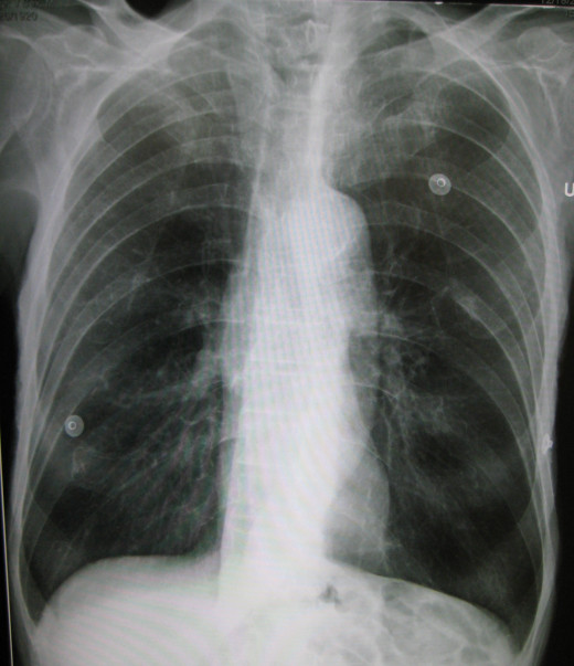 Patient with Severe Emphysema