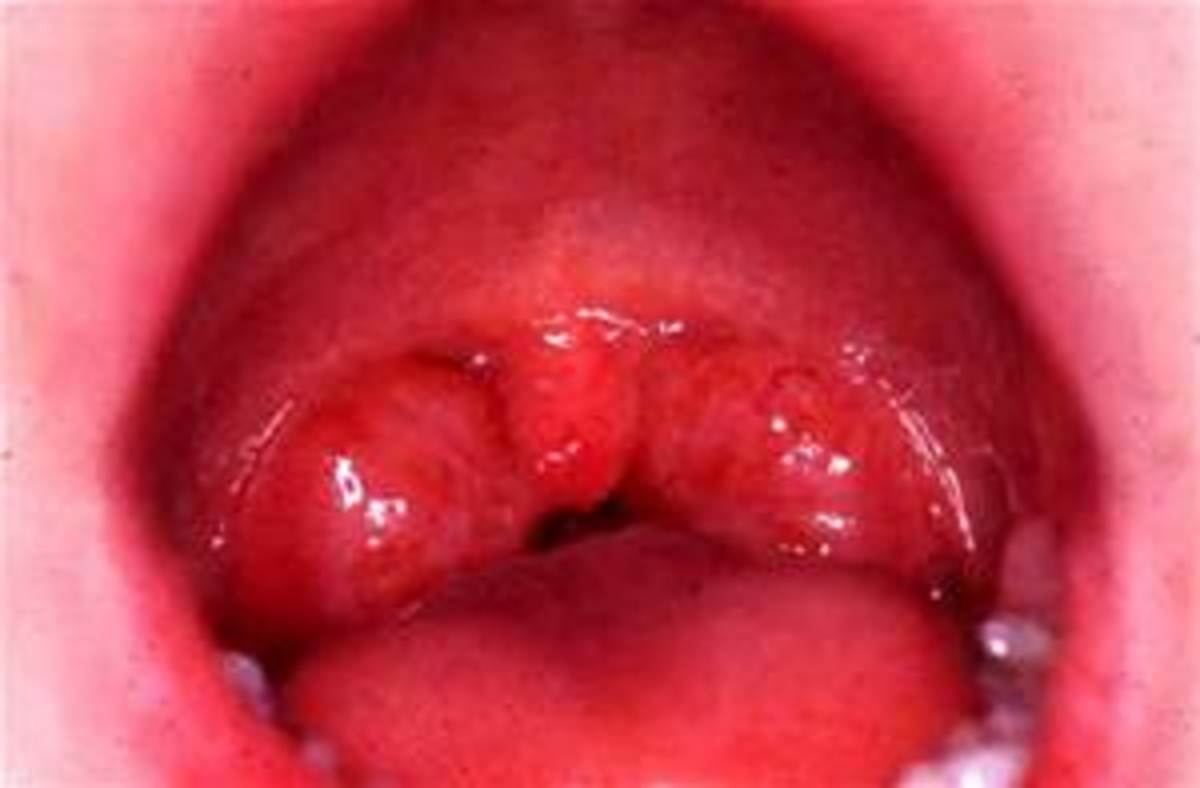 adult infections of Causes throat