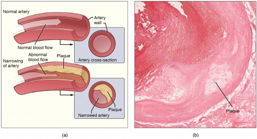 Images showing normal artery on left top,plaque formation on right side image and narrowing of arteries on left bottom.