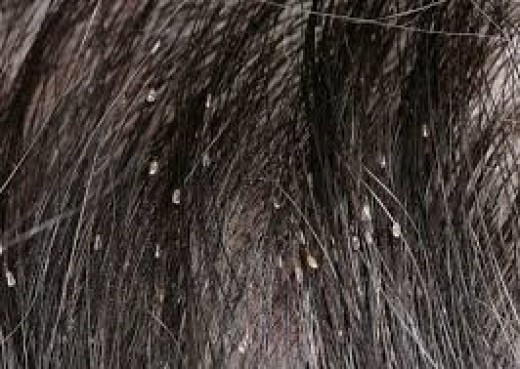 lice head hair rid eyebrows