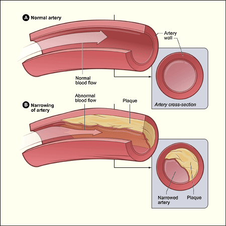 Diagram of Atherosclerosis that is clogging of the arteries.