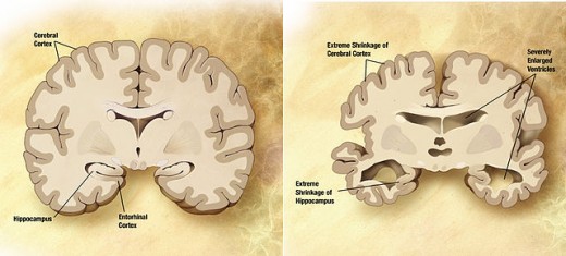 Normal brain and brain of Alzheimer's patients 