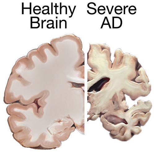 A drawing of a healthy brain compared with that of one afflicted with advanced Alzheimer's Disease.