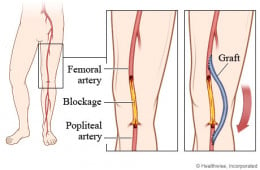 Understand Surgery: Femoral Popliteal Bypass