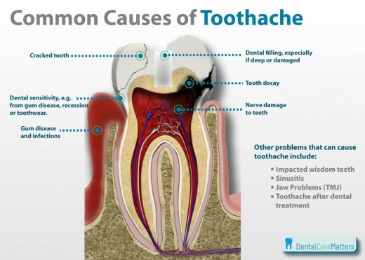 Common Causes of Toothache
