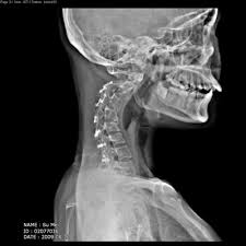 Cervical Kyhosis