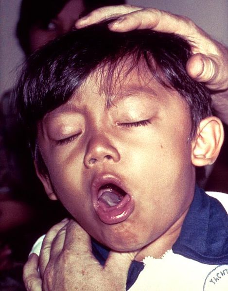A child with whooping cough. What a terrifying sound!