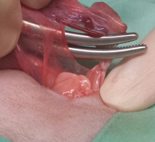 The right ovary- notice the small ligature over the ovarian blood vessels just below the two forceps.