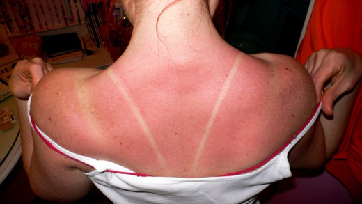 A sunburned skin isn't something to feel so happy about.