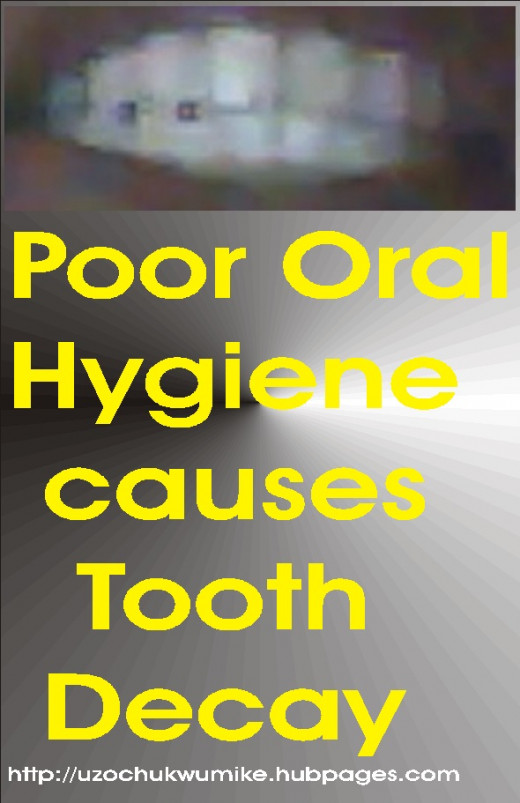 Poor oral hygiene is a call to teeth decay. So, tooth/teeth decay can be caused as a result of poor oral hygiene. 