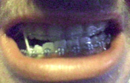 Soon after we realized the tooth was hooked and pulling my other teeth down with it, I had it removed. Rubber bands were used to pull the teeth back up.