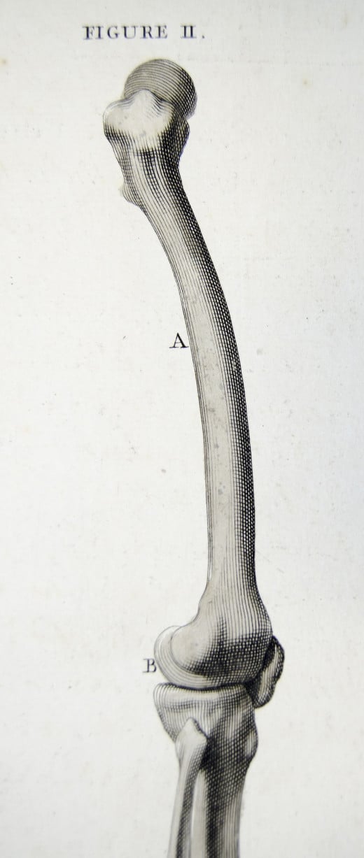 The bones of the upper leg, such as the patella and femur, are commonly affected 