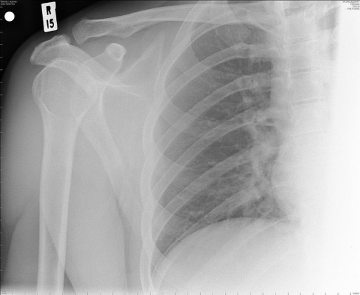 The shoulder is comprised of the scapula and humerus