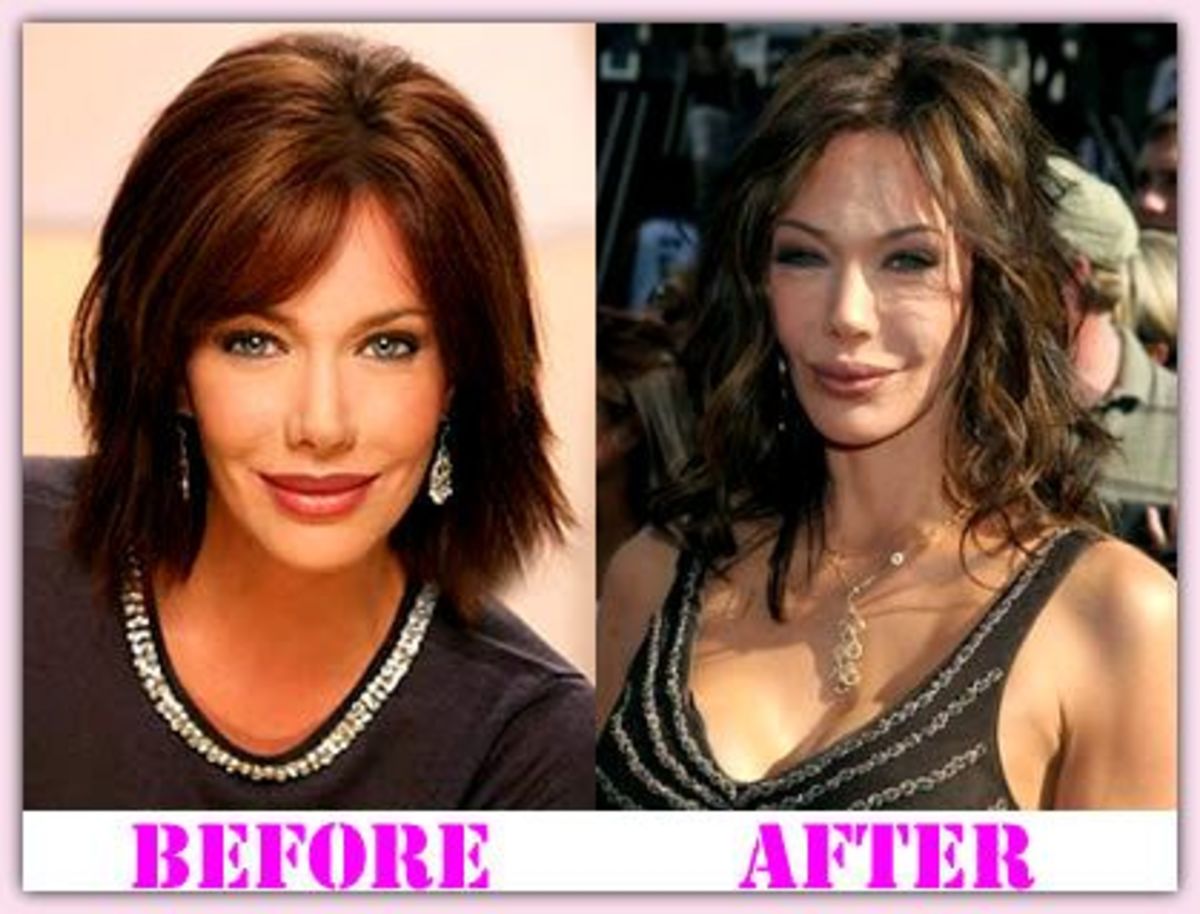 Plastic Surgery Disasters & Reconstructive Miracles HubPages