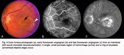 Fluorescent Angiography