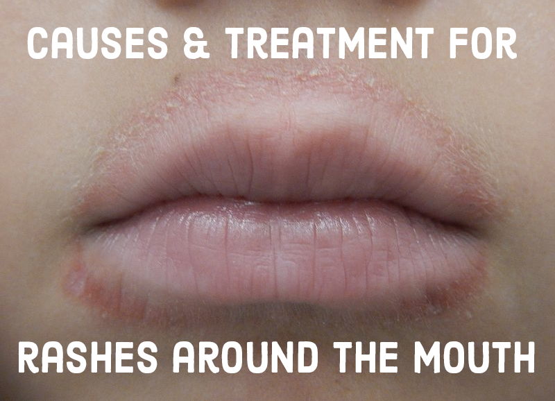 What does it mean when you have a dry patch on your lip?
