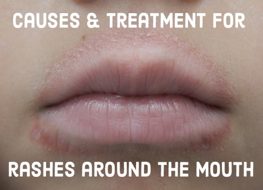 Rash Corners Of Mouth 18
